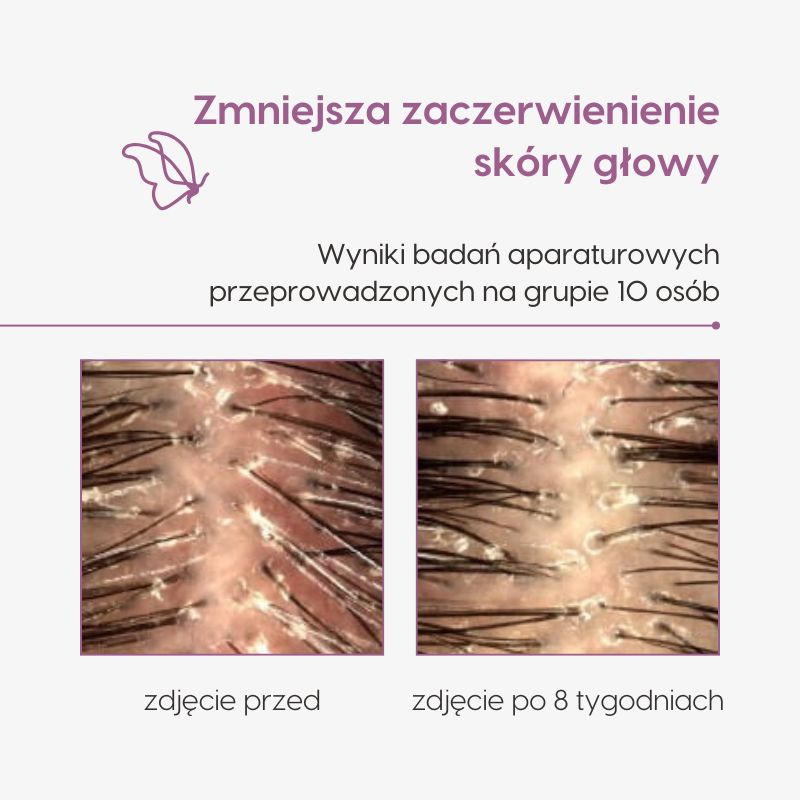 Laktobionowy peeling do skóry głowy_Mawawo_Badania